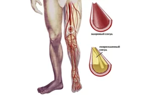ateroskleroz sosudov nishnih konechnostey