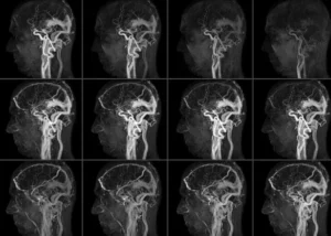 mr-angiografiya s kontrastom