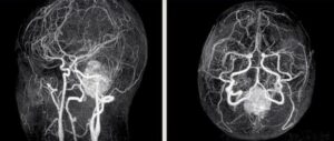 mr-angiografiya s kontrastom