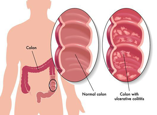 Неспецифический язвенный колит - симптомы и лечение