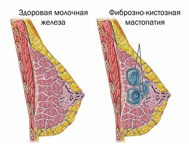 мастопатия