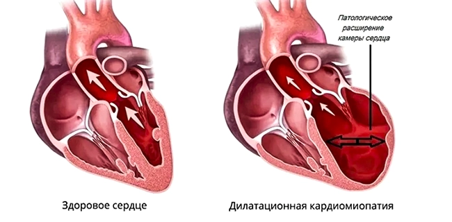 застойная кардиомиопатия