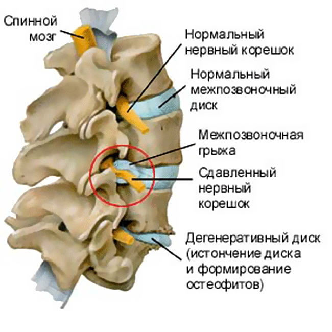 остеохондроз