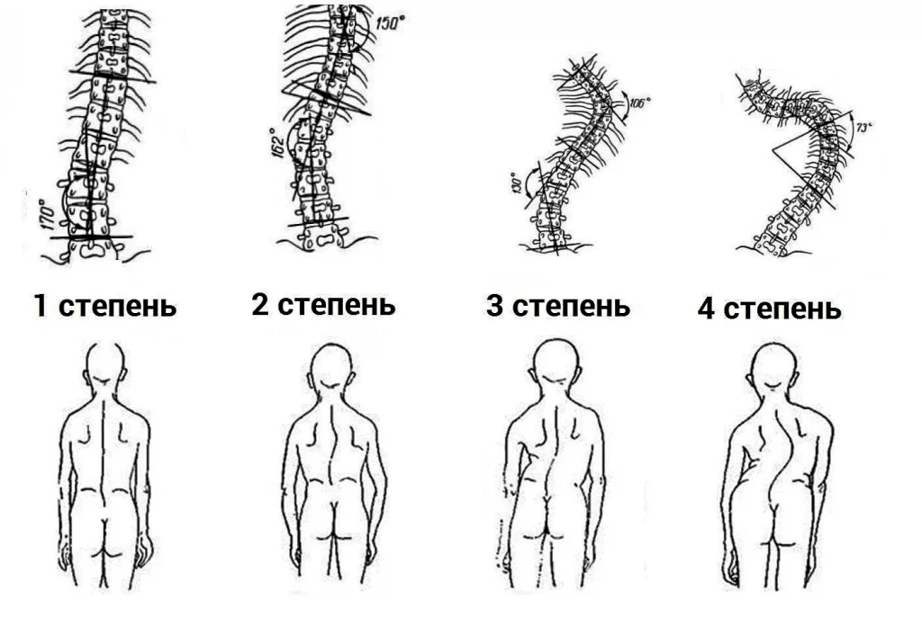 Дегенеративный сколиоз.