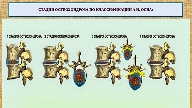 стадии остеохондроза