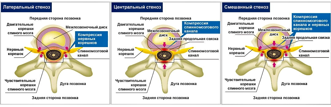стенозы позвоночного канала
