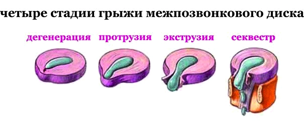 стадии грыжи